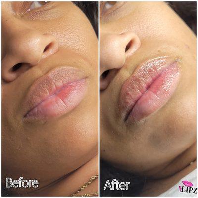 Hyaluronic Lip Filler