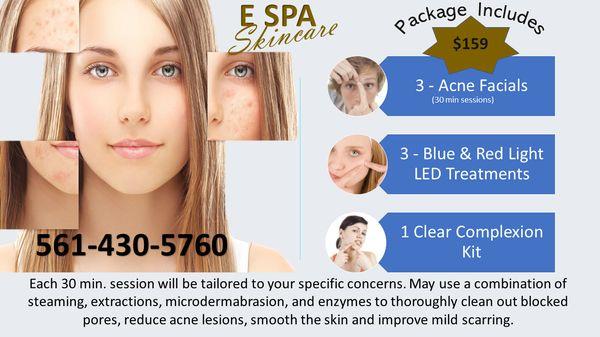$159. 3 acne facials with added light therapy and Microderm 561-430-5760