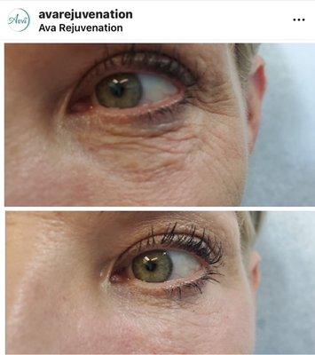 Even more beautiful after a little under eye filler and Botox. Thank you Nurse B.