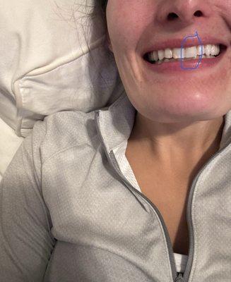 Post-fix! 24 hours later and it feels and looks amazing.