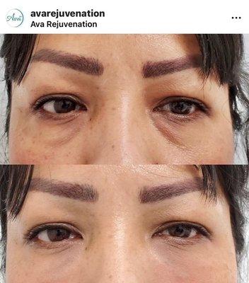 Lunchtime under eye rejuvenation, using Restylane dermal filler.