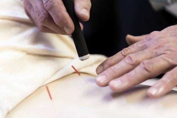 Moxibustion treatment