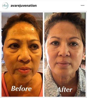 Dermal filler rejuvenation