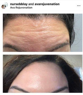 Smooth forehead lines with Botox