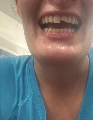 Post squash racket to the mouth.