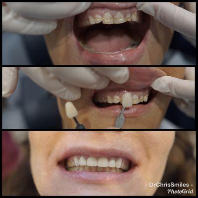 An amazing smile transformation!