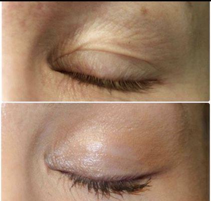 Plasma Pen Fibroblast skin tightening - Plasma Pen   will lift and remove saggy eyelids and under eye bags and wrinkles. Phiion technolog