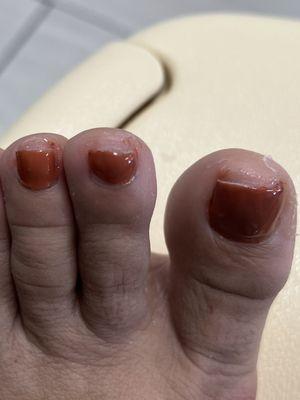 Bad pedicure!