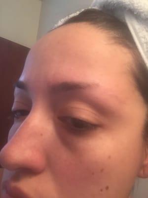 This is the eyebrow that is now missing a chunk of hair