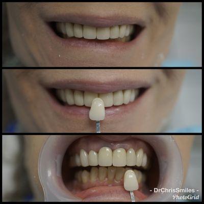 The art and science of dentistry!  Coloring matching of crowns are made easier with the availability of various shades, or custom shades!