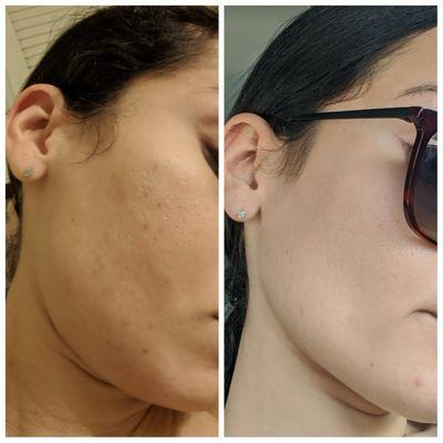 Micronedling before and after 1 treatment
