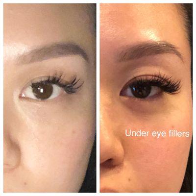 Under eye fillers