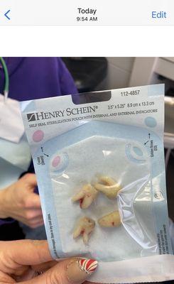 Fastest wisdom teeth extraction in my life! Super smooth process.