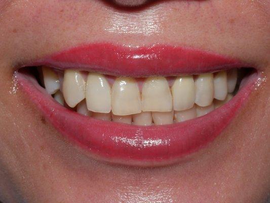 Front tooth crowns blending in with pearly whites