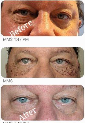 Plasma lift class model. He is very happy with the result.