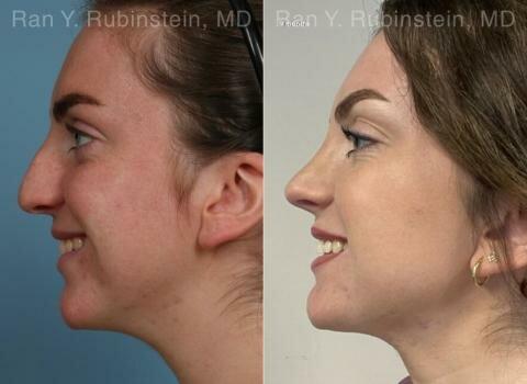Dr Ran Rubinstein, MD-Rhinoplasty Specialist