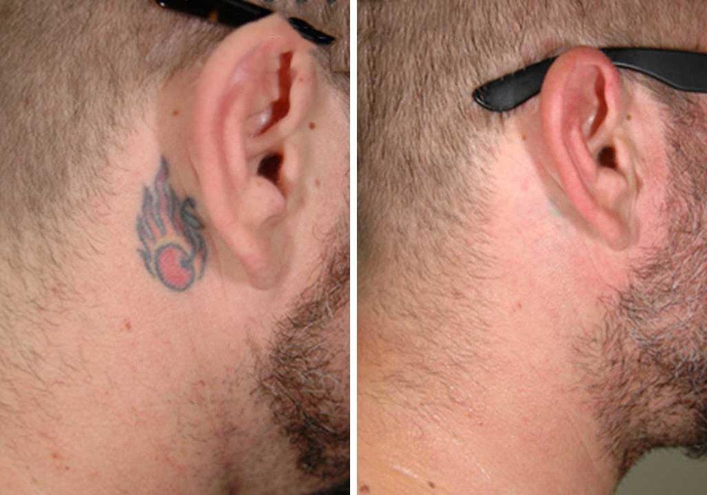 Reversatatt Tattoo Removal