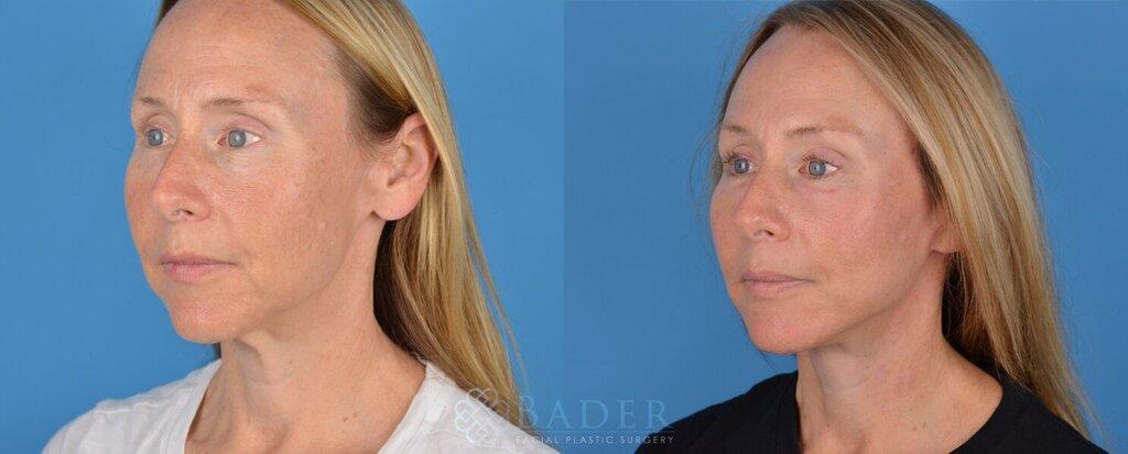 Bader Facial Plastics