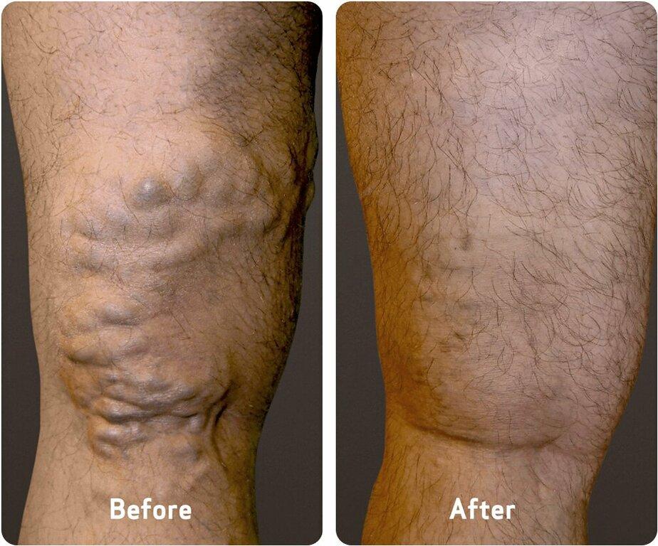 USA Vein Clinics