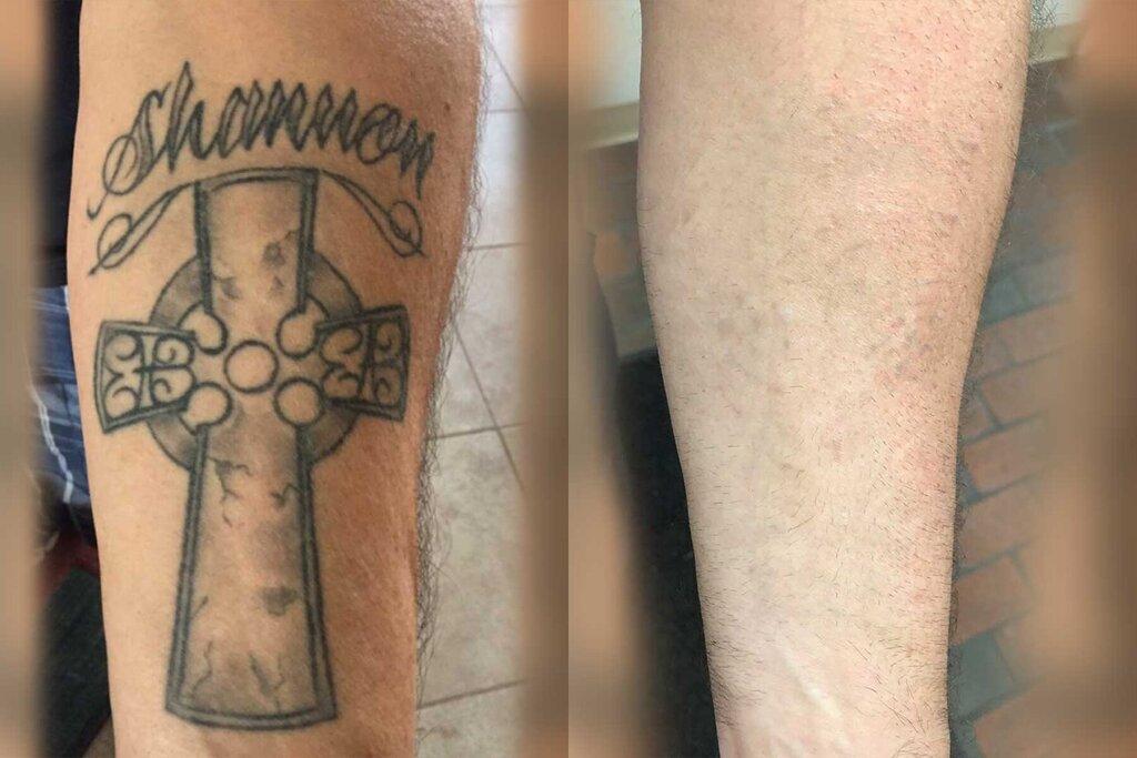 Taketatt Tattoo Removal