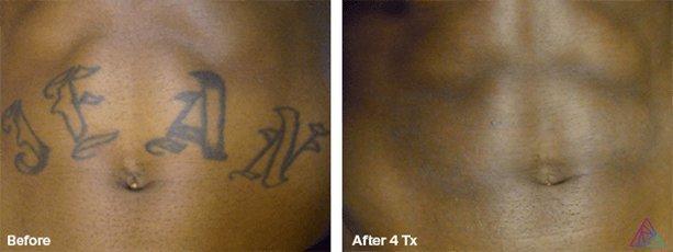 Ink Doubt Laser Tattoo Removal