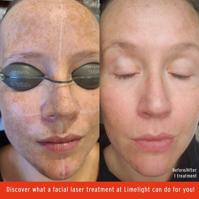 Limelight Laser and Medical Spa
