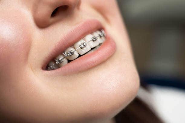 Diamond Braces Orthodontist