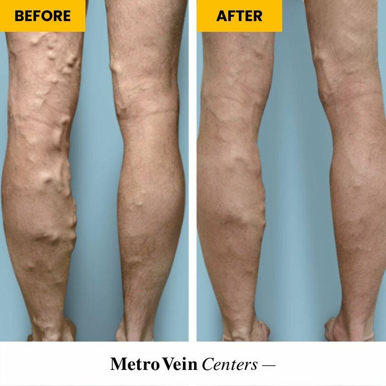 Metro Vein Centers