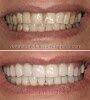 Dental Veneers Specialist on Wilshire