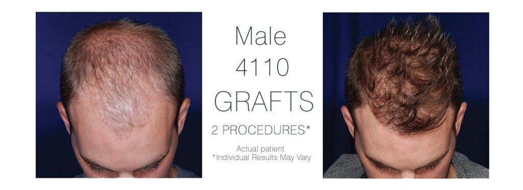 Ohio Hair Restoration