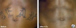 Removery Tattoo Removal & Fading