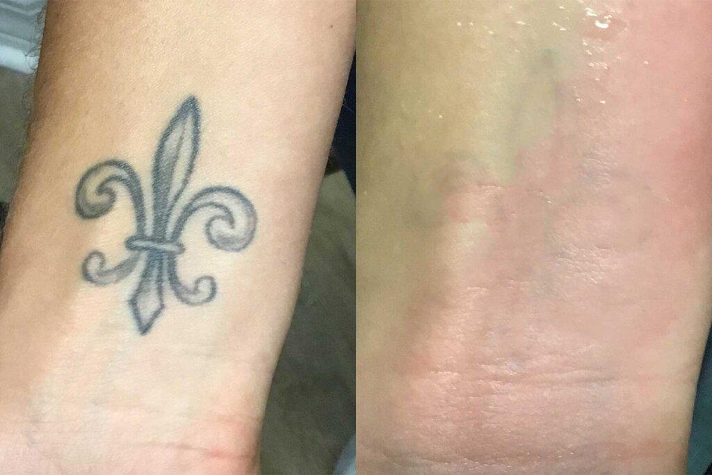 Reversatatt Tattoo Removal