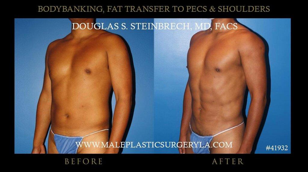 Male Plastic Surgery Los Angeles