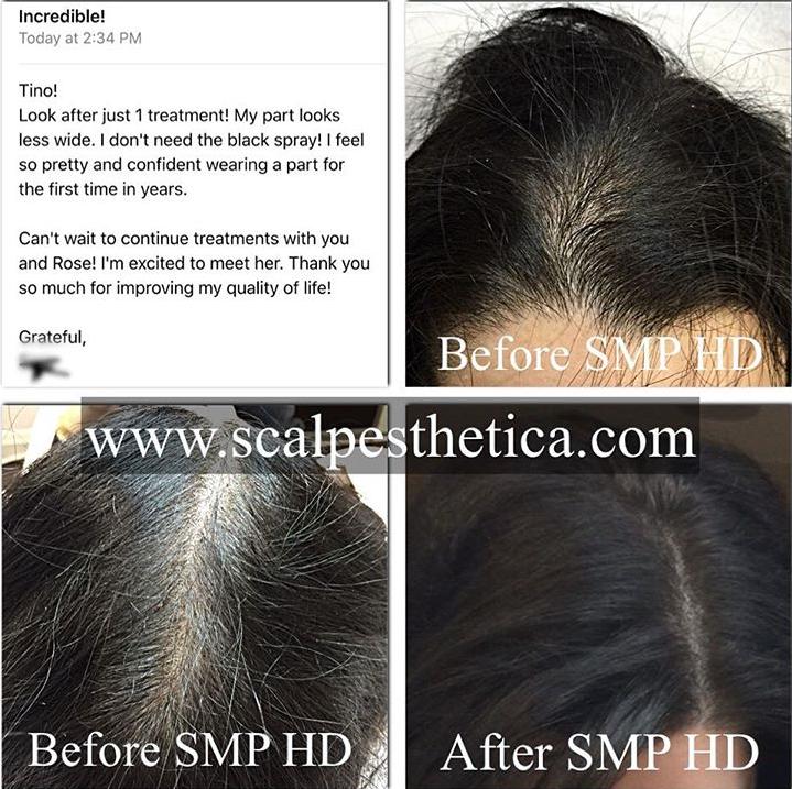 Scalp Micropigmentation Center