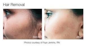 Comfort Blend Electrolysis