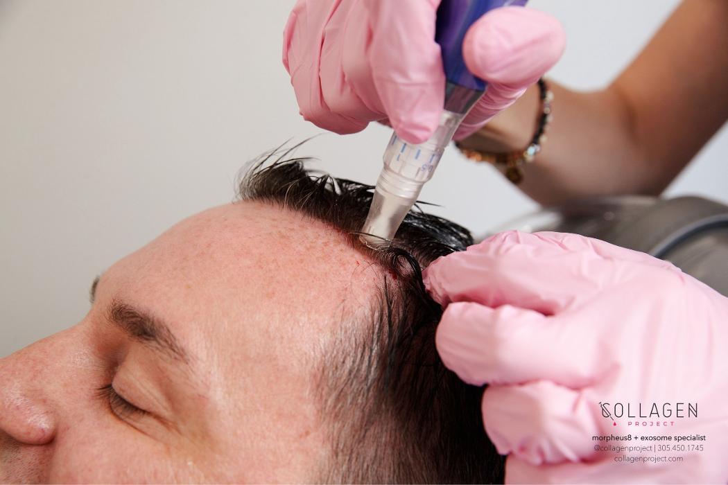 morpheus8 collagen project