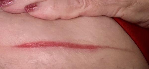 This photo is under my breast and was taken five days after the mammography. Brutality!