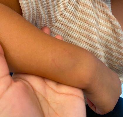 Bite mark on arm