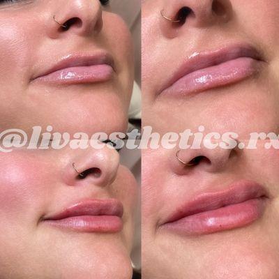 Lip Augmentation