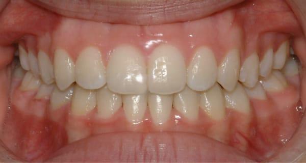 Rachel-After(20 months treatment with Damon braces)