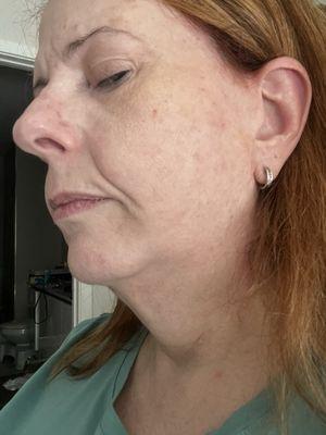 Side view 1 of my face and neck 5/13/25