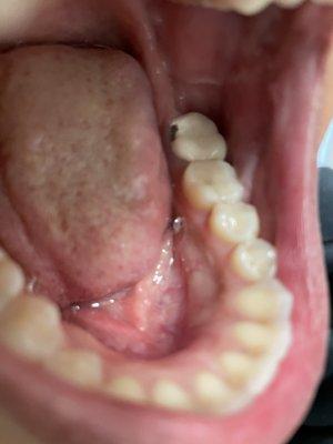 back tooth crown chipped