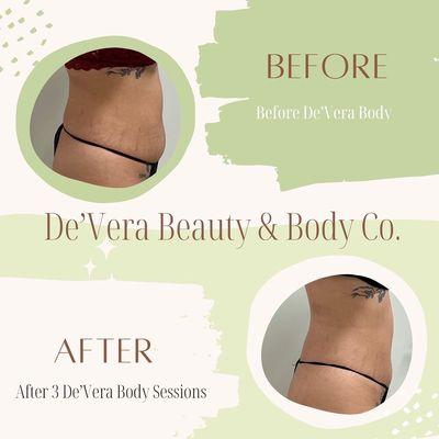 De'Vera Body Contouring