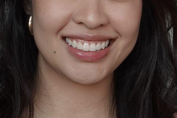 After Invisalign Treatment