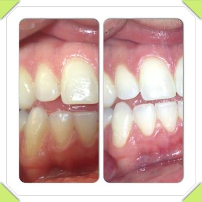 This client came 12 shades whiter in an hour! Awesome. Another satisfied client!