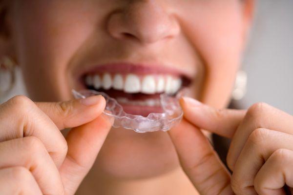 Clear Aligner Options at Indianapolis