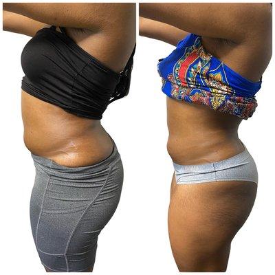 Client has had 2 sessions of cavitation with a 30 minute body warp and wood therapy