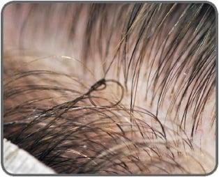 MicroPoint Links: Process of tying 4 strands of hair to one of your own hair in crown area. Consultation required.