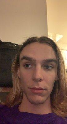 The evening after my surgery, very little swelling