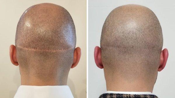 SMP camouflages scars on the scalp by depositing pigment with small needles to create the illusion of hair follicles.